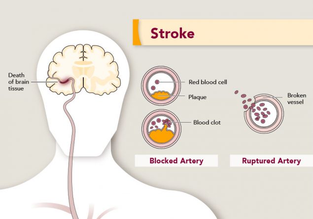 stroke-brain-tissue-medium